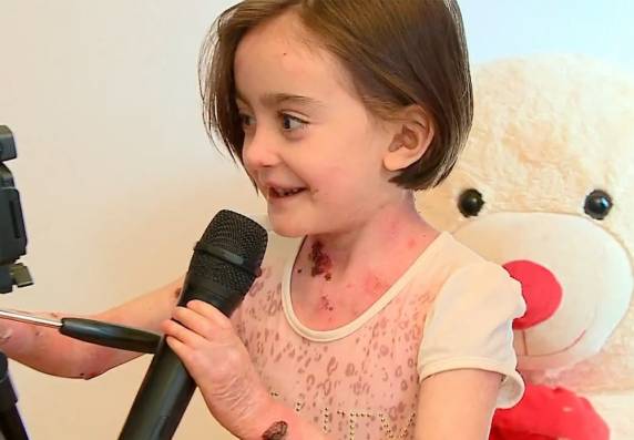 Raissa Victória, 7 anos, sofre de epidermólise bolhosa. Doença causa bolhas e lesões pelo corpo após o 

simples toque na pele da menina