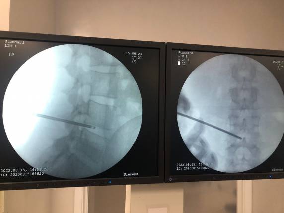 Recentemente, foi realizado no Centro Cirúrgico do Hospital Vida & Saúde, uma cirurgia percutânea de hérnia ? a primeira deste tipo realizada no município