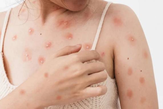 Doença é transmitida principalmente pelo contato direto com lesões na pele, secreções respiratórias e saliva